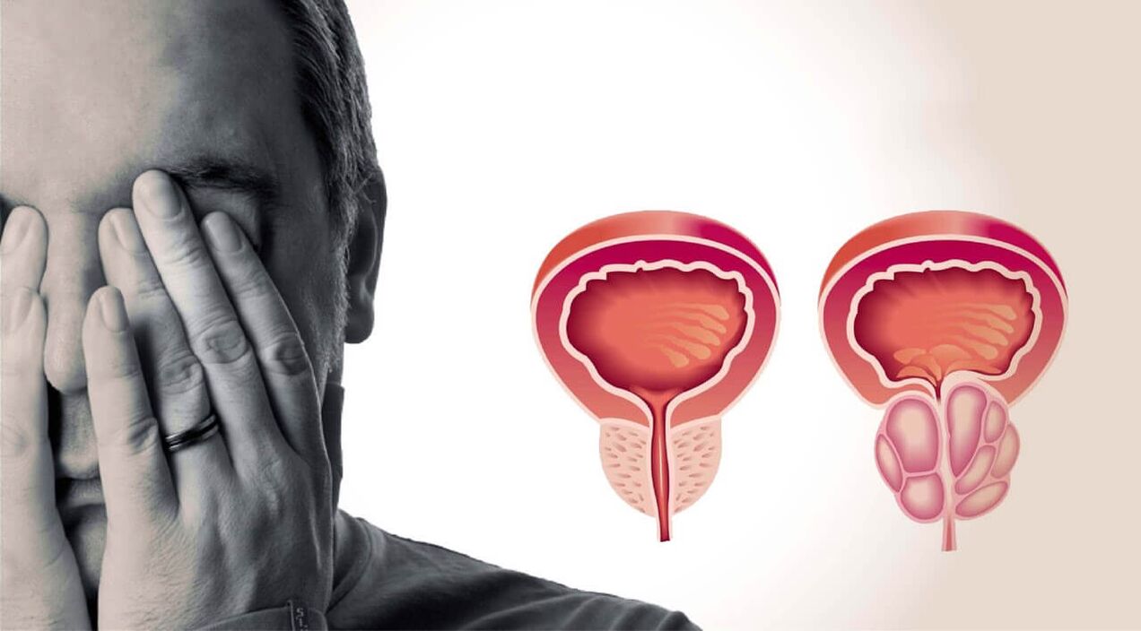 Zdrava i bolna prostata kod muškaraca